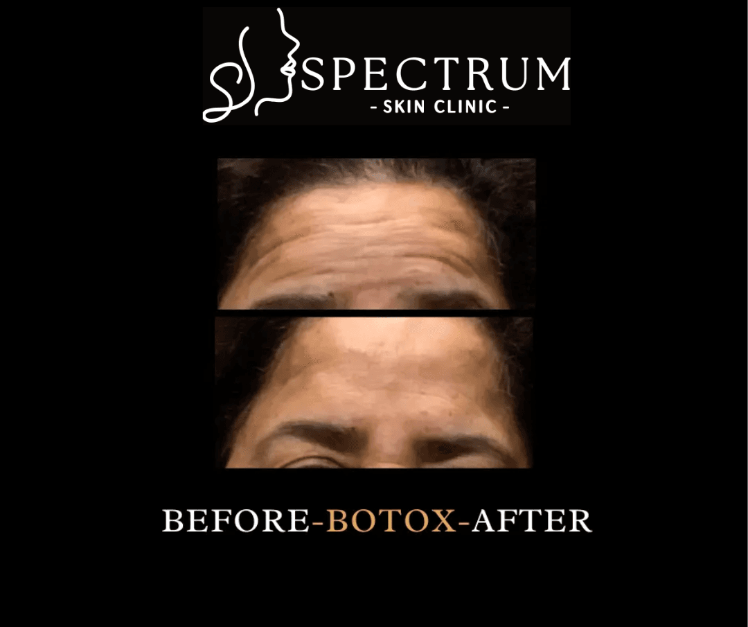 What Does Botox Treat?