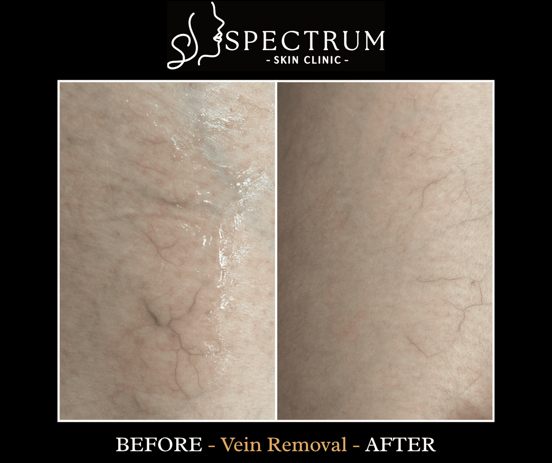 Before and After Vein Removal