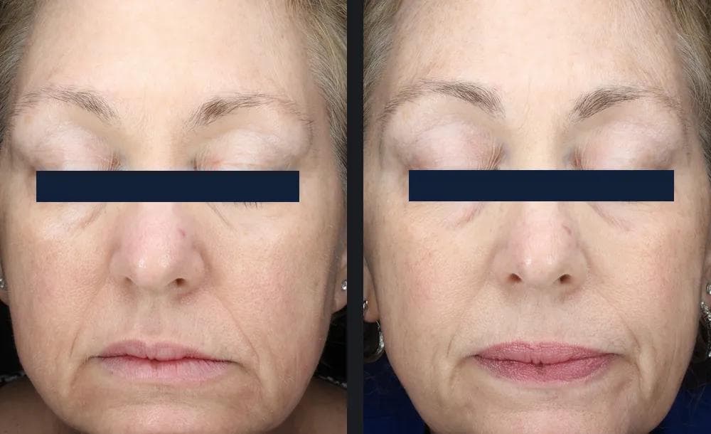 How Sculptra Works: A Biological Approach to Anti-Aging