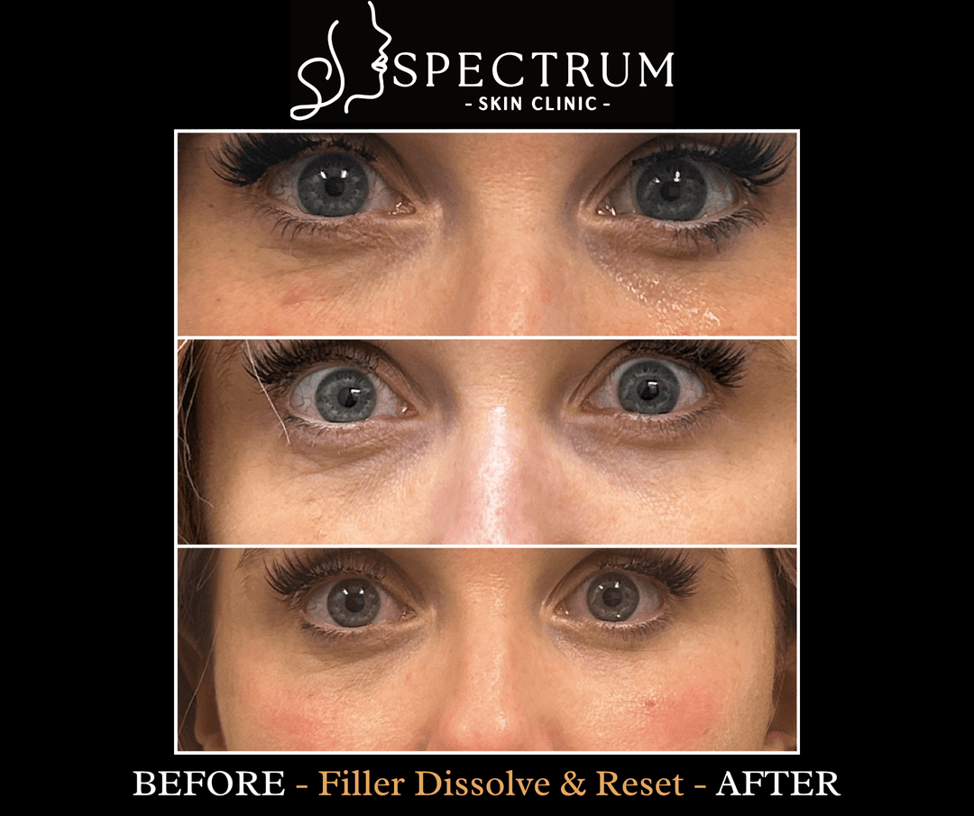 When Can You Refill After Dissolving?