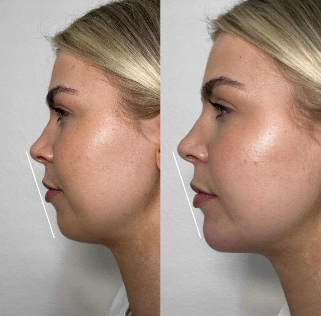What Concerns Can Jawline Filler Treat?