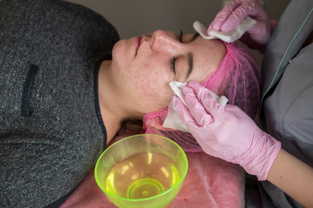 Acne Facial