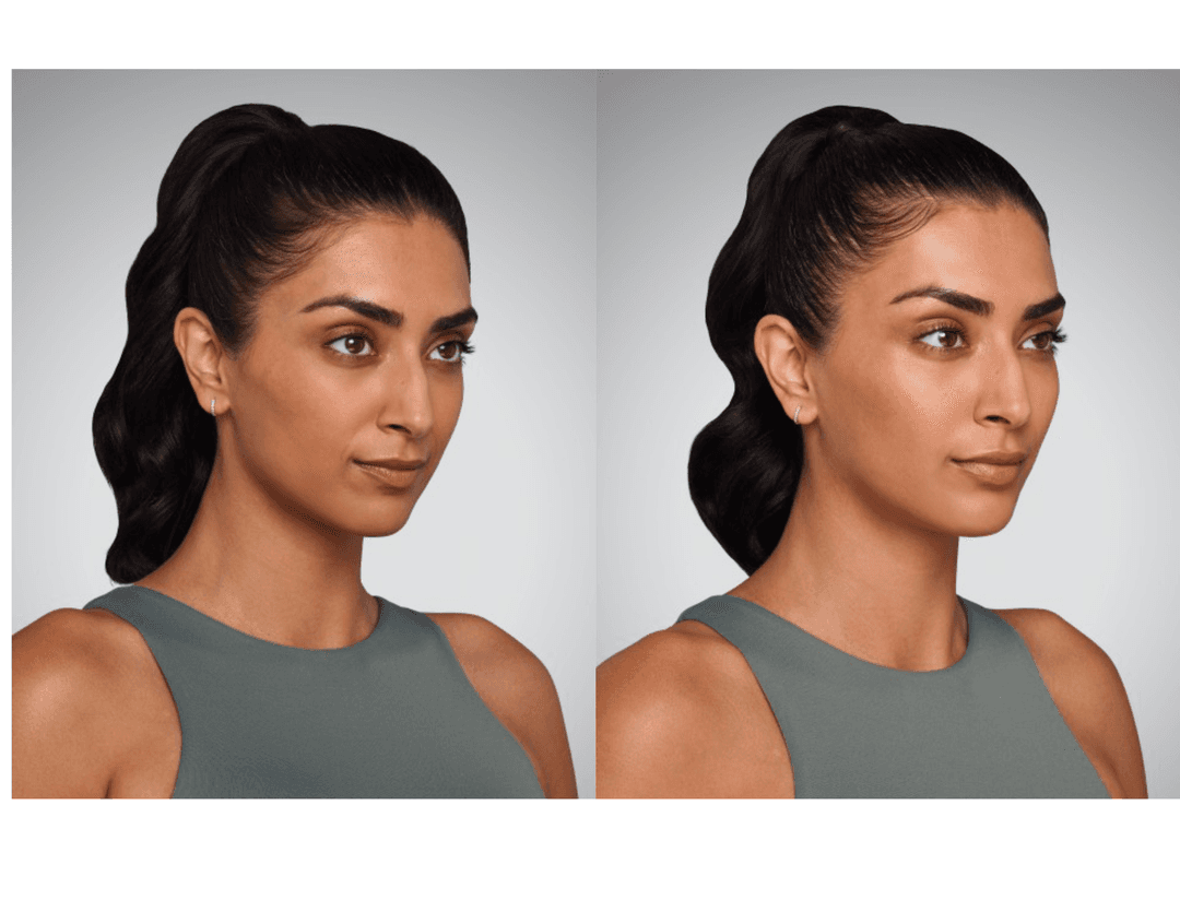 Juévederm Before and After