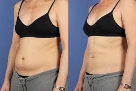 What to Expect During and After Treatment