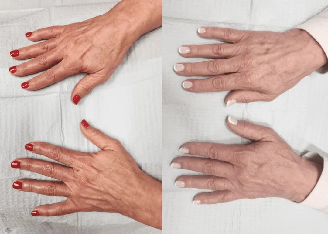 What Concerns Can Hand Filler Treat?