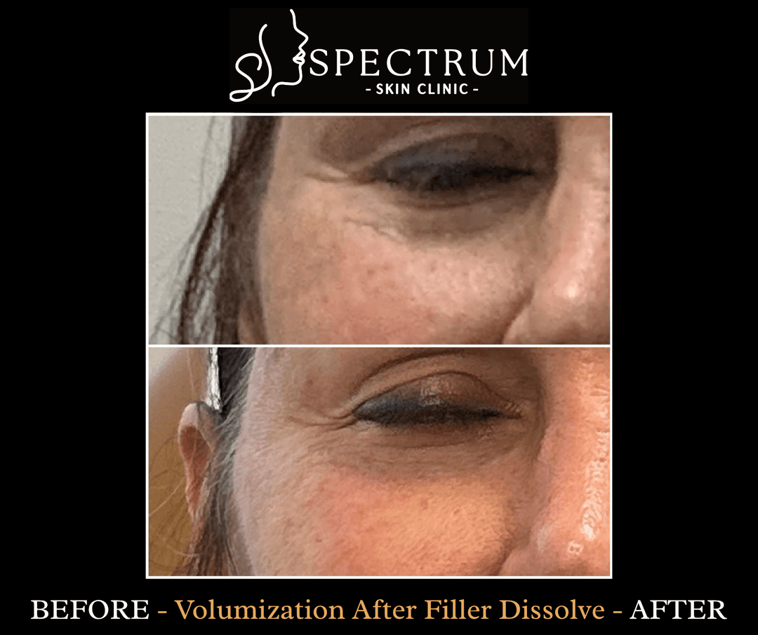 Volumization After Filler Dissolve