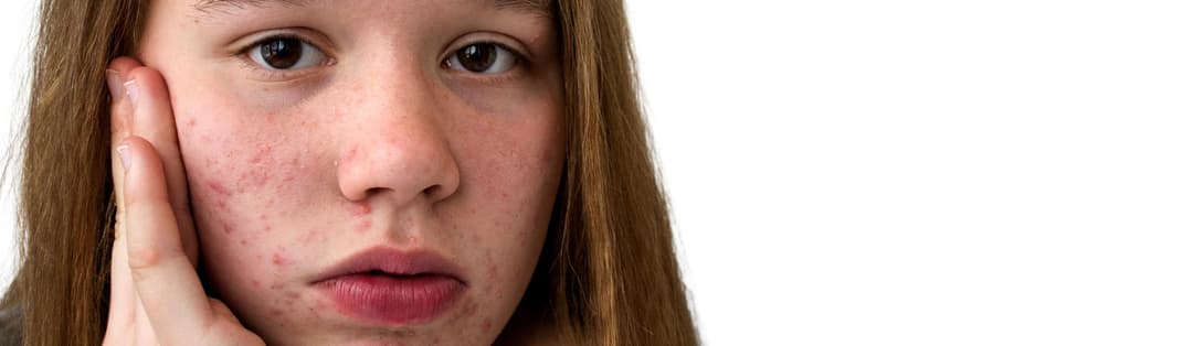 Acne Scar Treatment