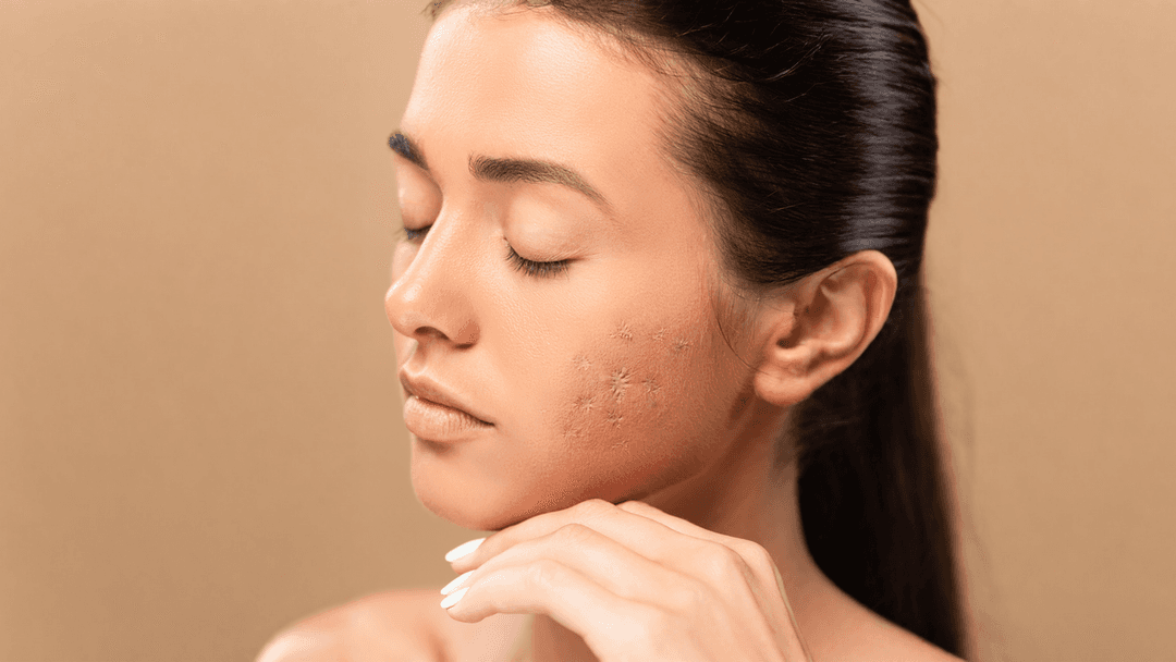 How to Get Rid of Acne Scars: Proven Treatments from Medical Experts