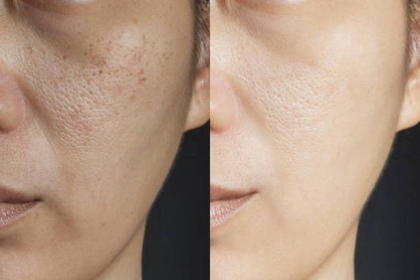 What is Melasma and what causes it?