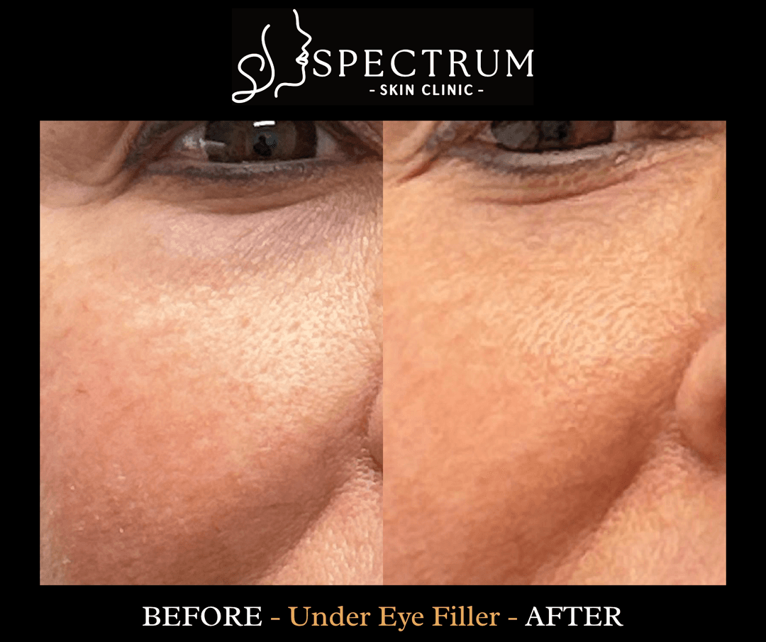 Under Eye Filler Before and After
