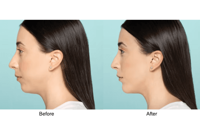 Before and After Results