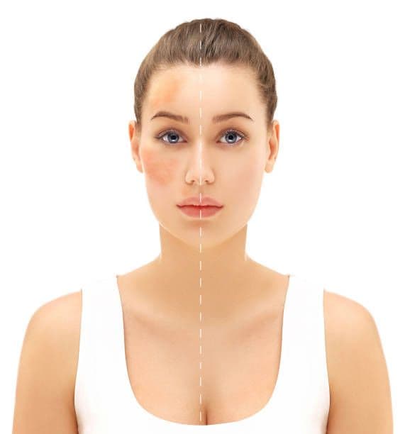 What treatments are available for Melasma?
