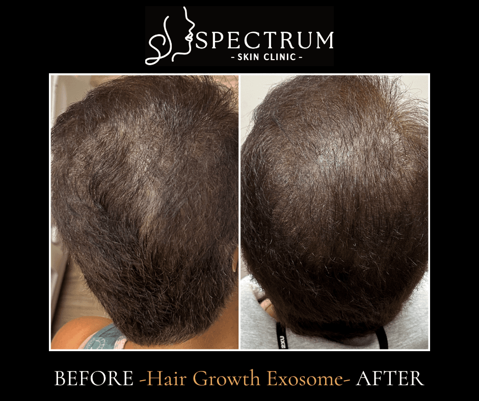 Several months in: fuller through the mid-scalp