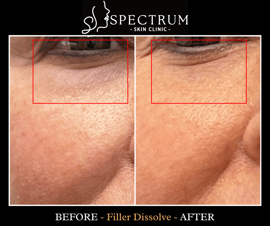 What Is Hylenex and What Fillers Can Be Dissolved?