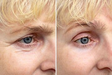 What Concerns Can Under Eye Filler Treat?