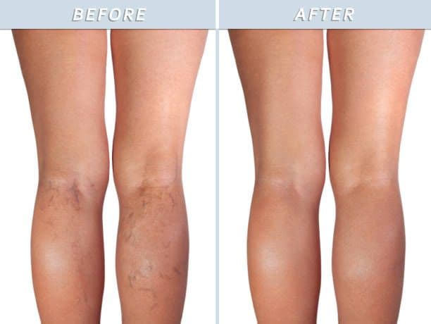 What Are Facial Telangiectasias?