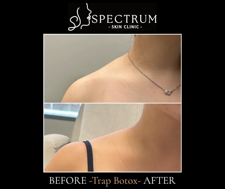 The Cosmetic and Medical Benefits of TrapTox