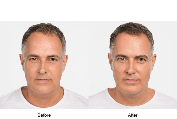 Radiesse Jaw Line Filler Before and After