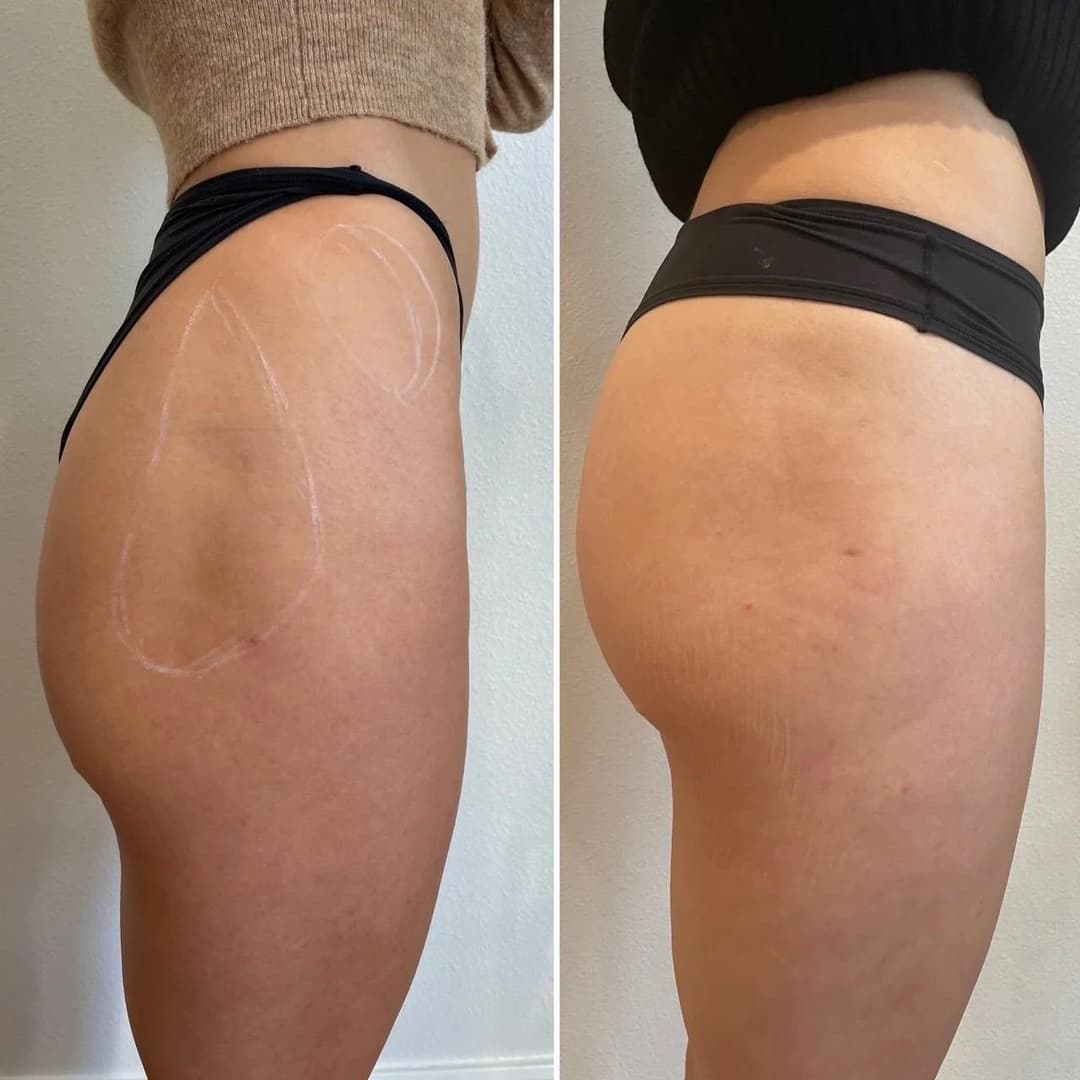 What Can a Non-Surgical BBL Address?