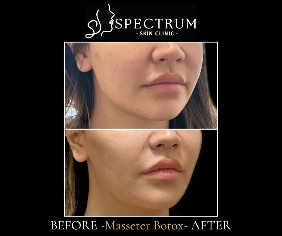 What Is the Masseter Muscle — and Why Does It Matter?