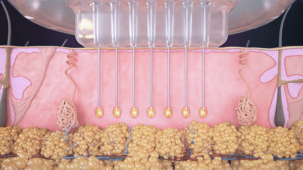 Matrix Pro® RF Microneedling