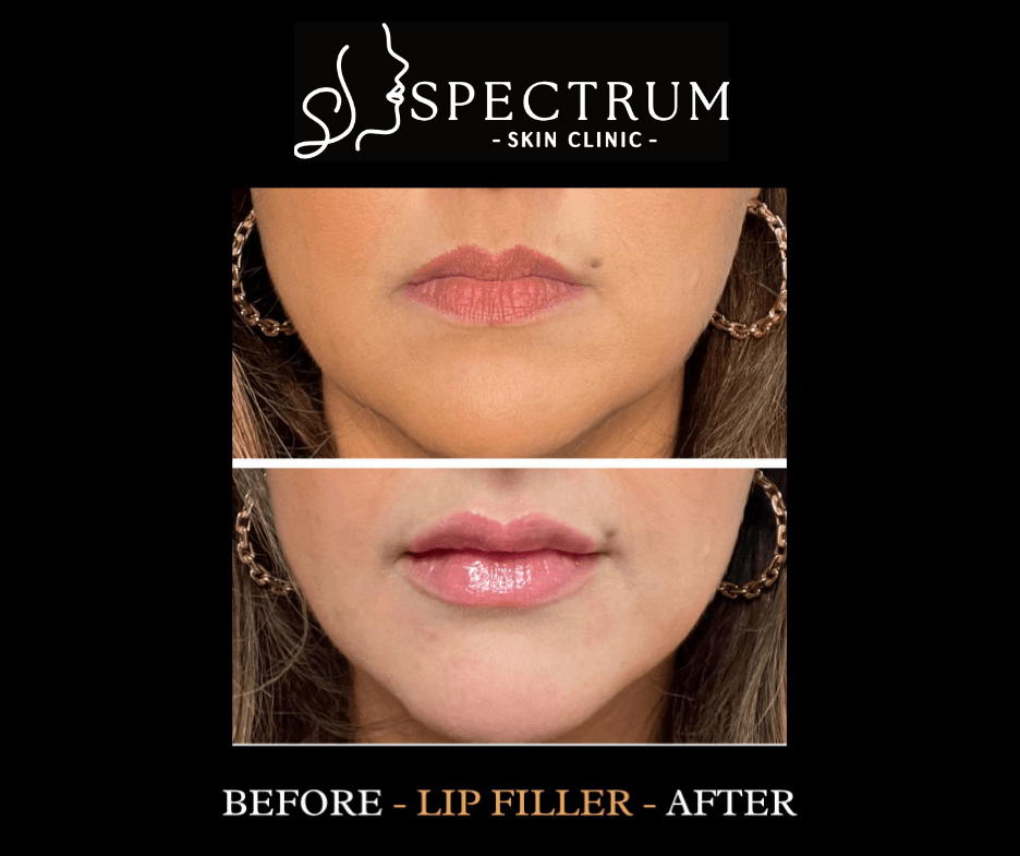 Why Patients Choose Lip Filler at Spectrum Skin Clinic