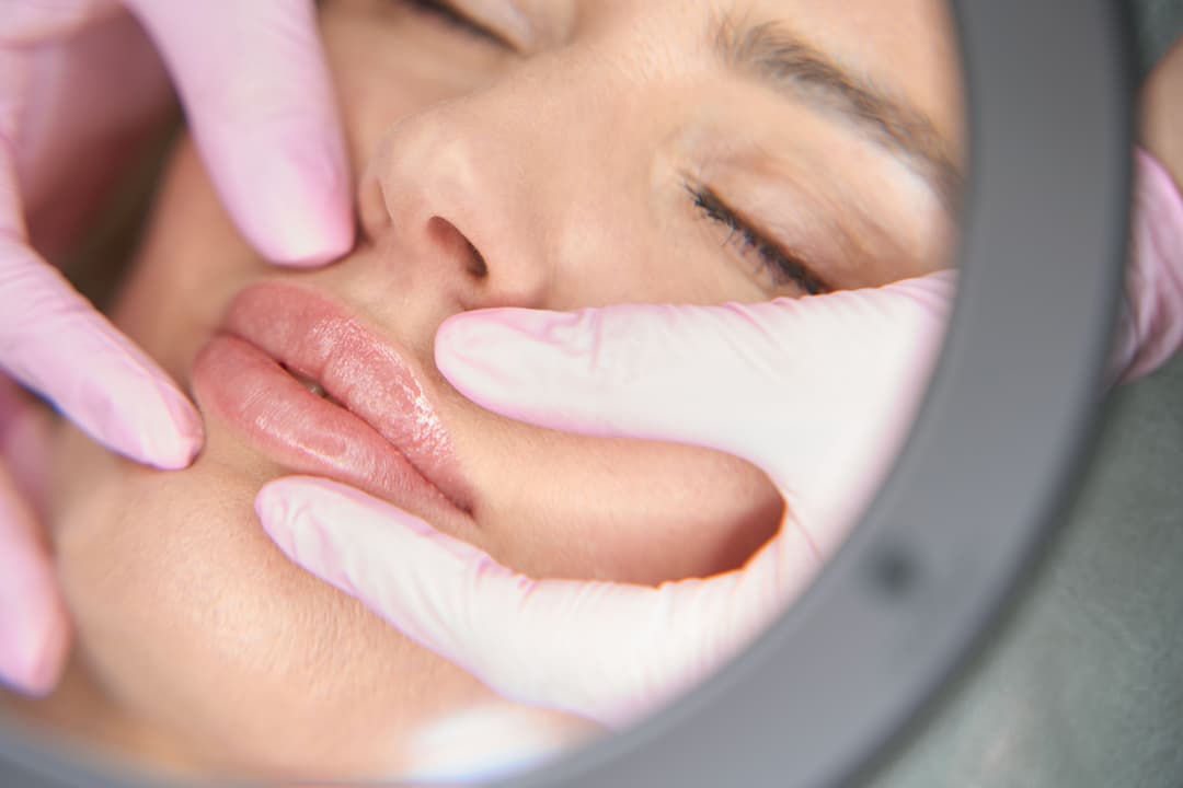 Natural Lip Augmentation After Dissolving Filler