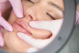 Filler Migration: Signs, Causes, and How It Is Corrected