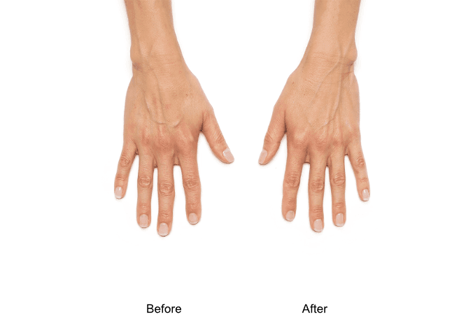 Radiesse Hand Filler Before and After
