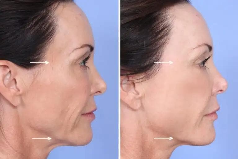 What Concerns Can Sculptra Address?