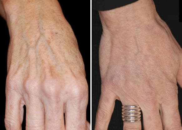 Why Get Hand Filler at Any Age?