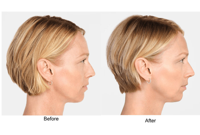 Radiesse Before and After