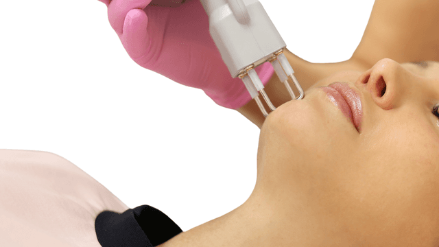 Image of Fractional CO2 Laser service