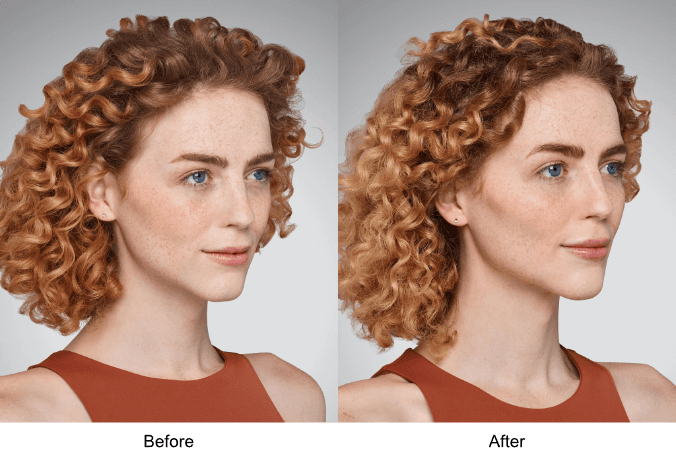 Juvéderm Voluma Jaw Line Before and After