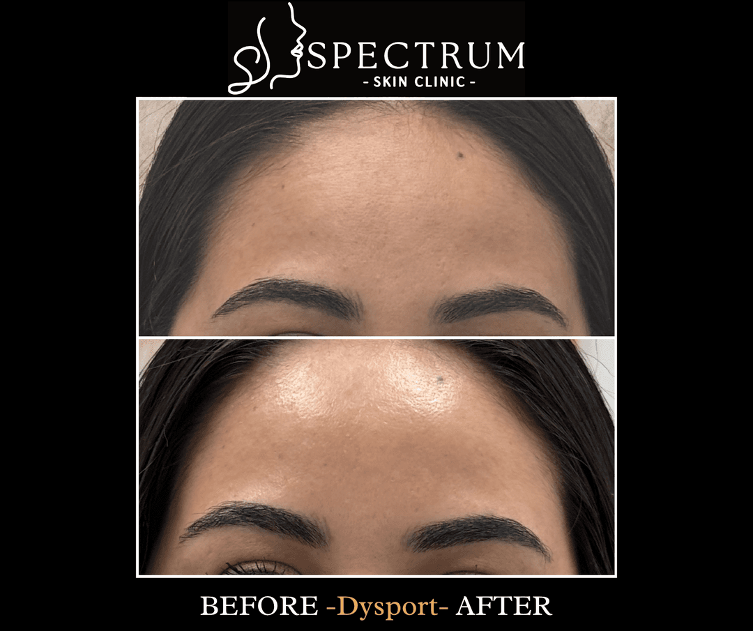 Dysport – Before and After Results