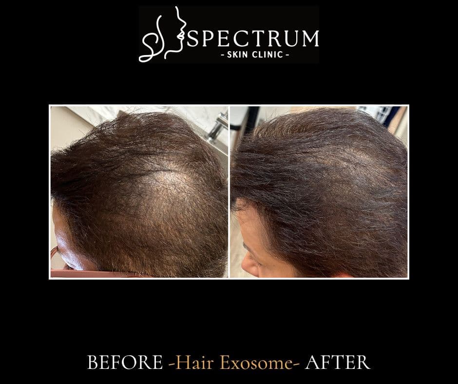 What eight months of hair exosome therapy actually looks like